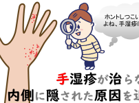 手湿疹の原因