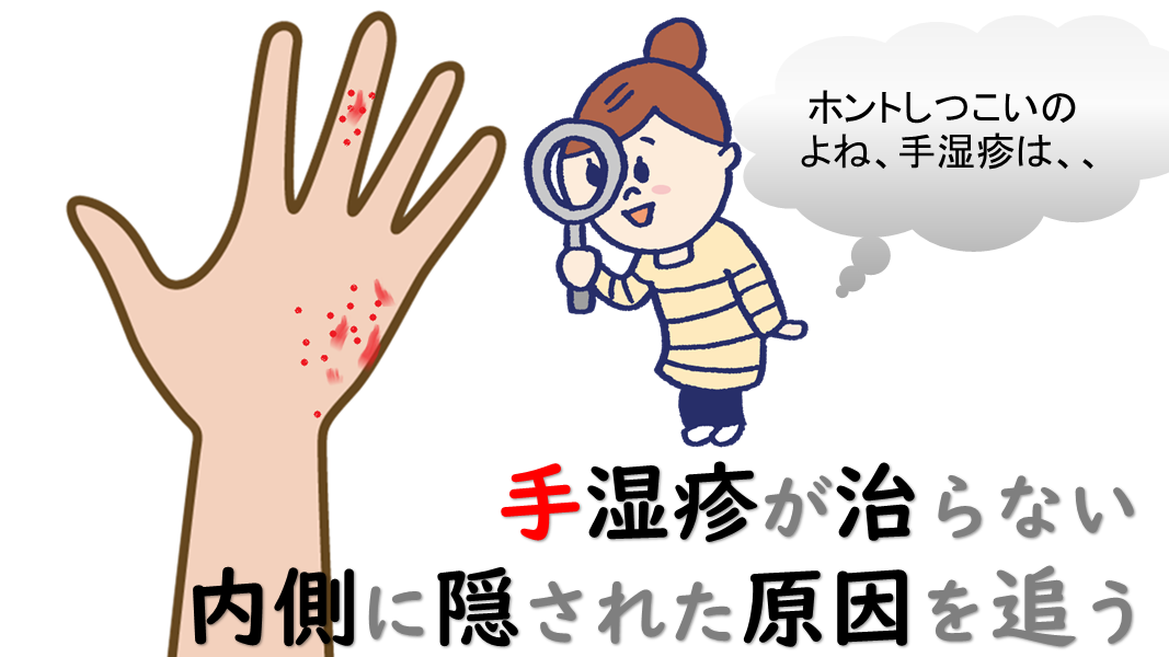 手湿疹の原因